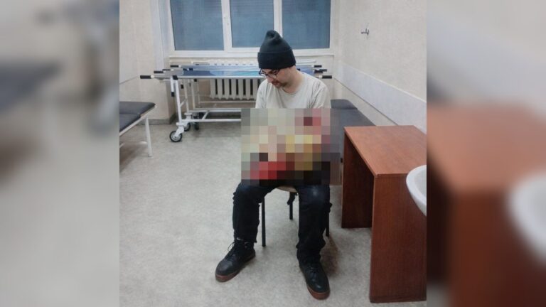 Одесит намагався відпиляти собі руку щоб уникнути мобілізації